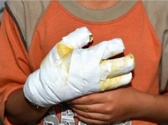 Quemados con pólvora. / Imagen de referencia.