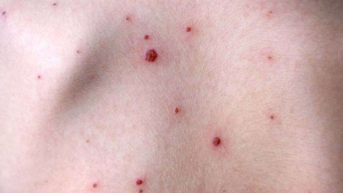 Secretaría de Salud confirma primer caso de viruela del mono en Santa Marta