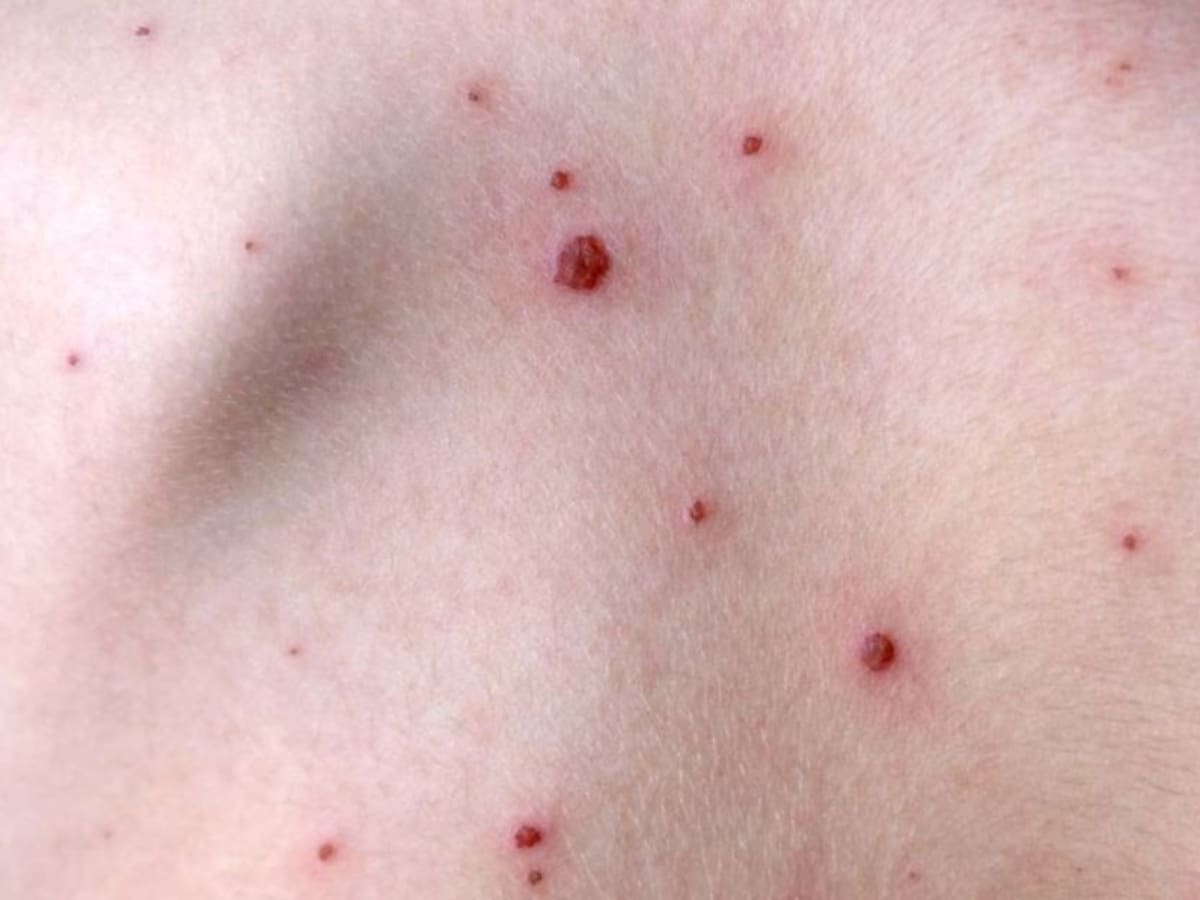 Secretaría de Salud confirma primer caso de viruela del mono en Santa Marta