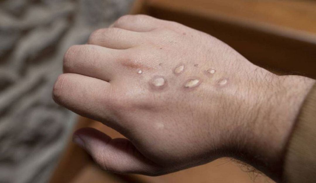 Hasta el momento la capital de Bolívar solo registra un caso confirmado de esta patología