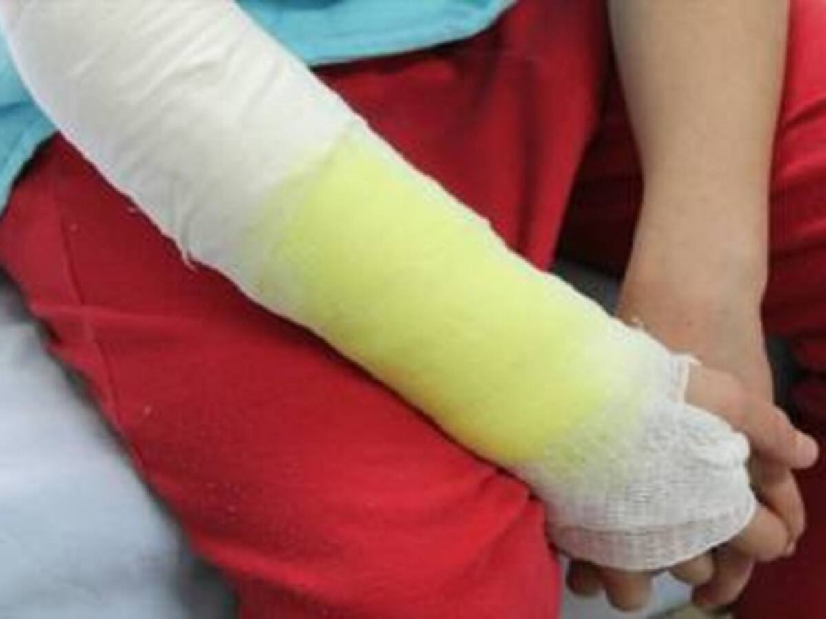 Avanza recuperación de niña quemada con aceite caliente por su padre