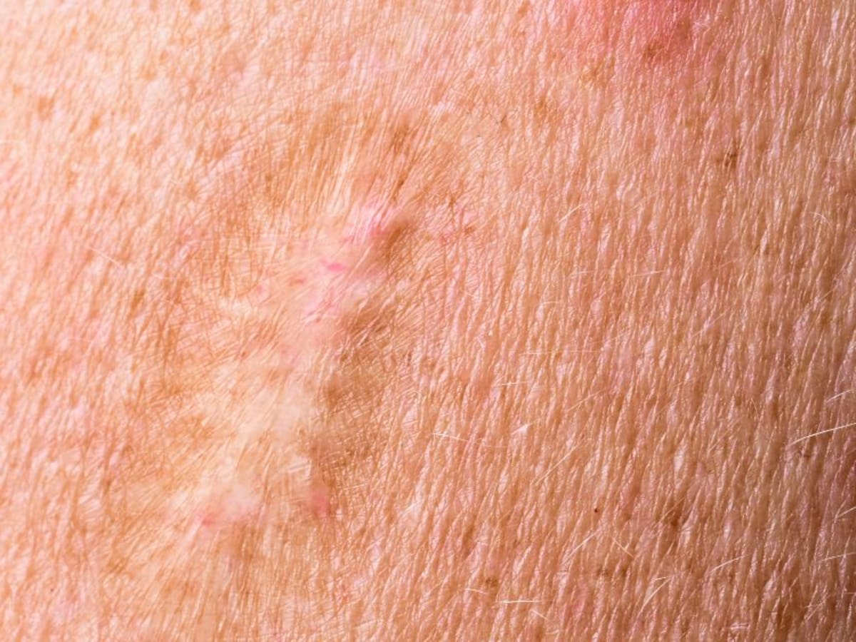 El ISCIII obtiene la secuencia completa del genoma de la viruela del mono