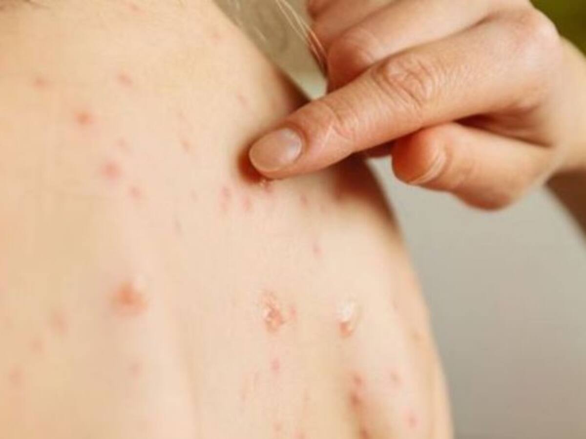 33 de los 39 casos de sarampión en Cartagena fueron reportados en julio