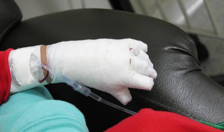 Quemado con pólvora en diciembre