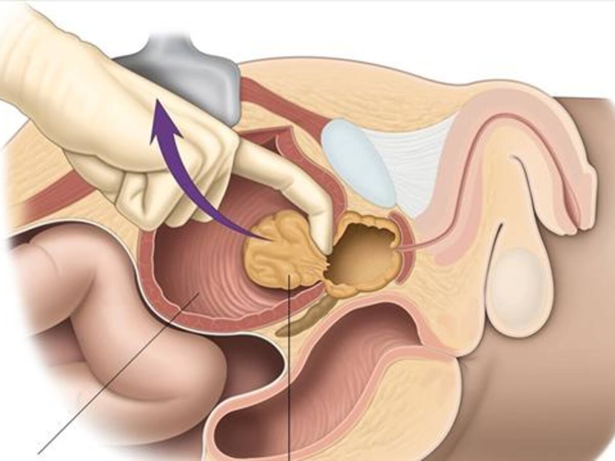 Prostatectomía