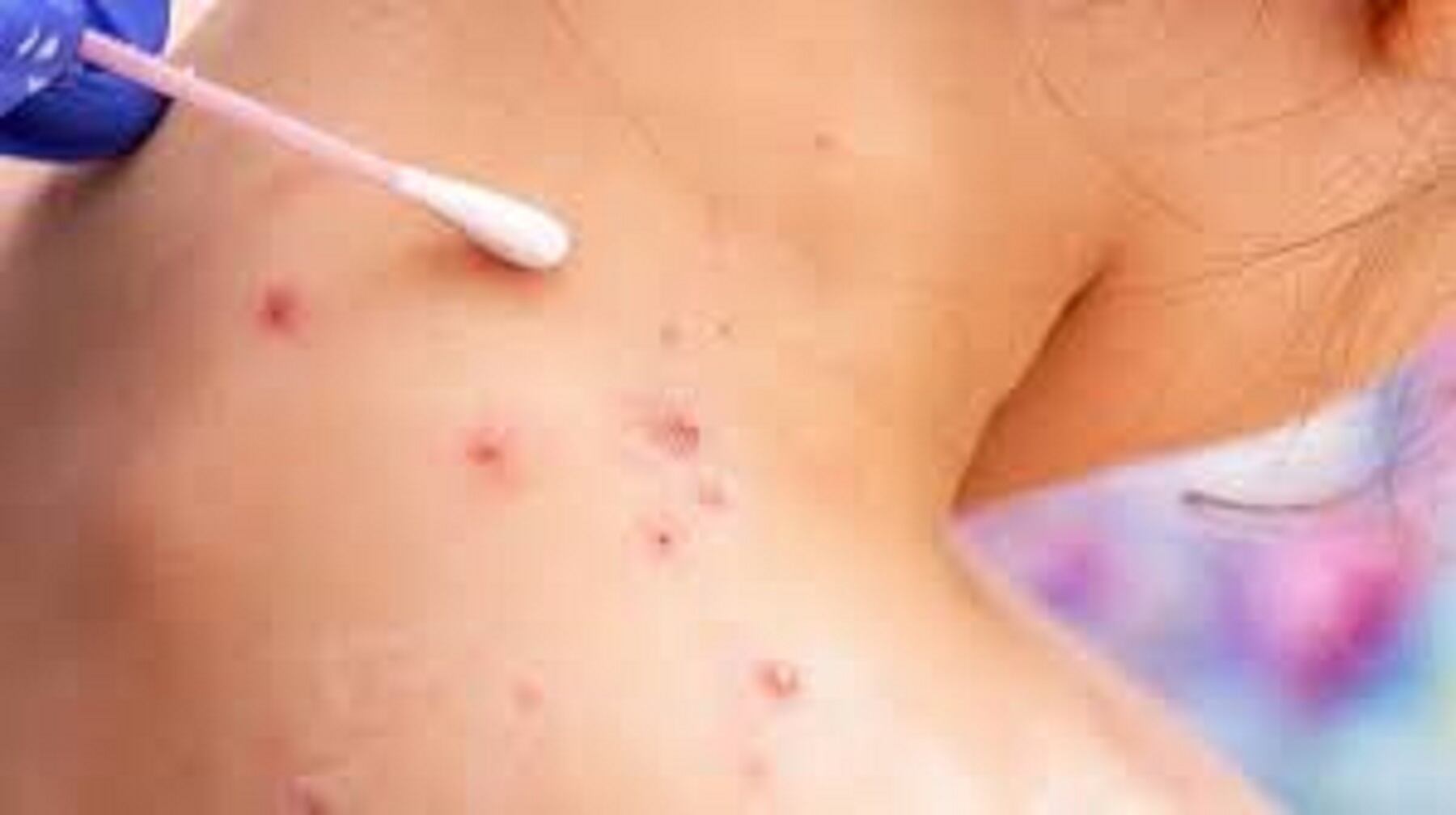 El Tolima el sexto departamento con más casos de viruela símica en Colombia