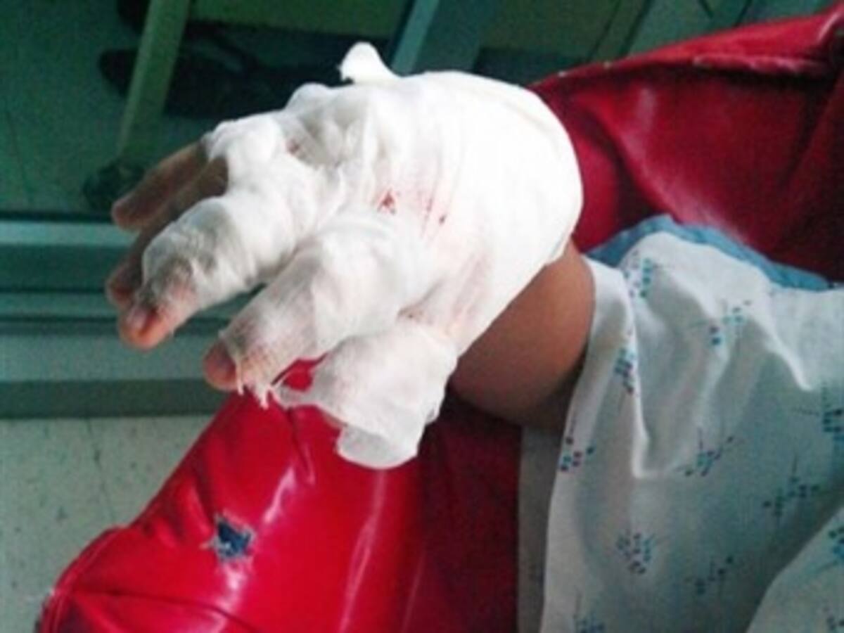 Madre quemó a su hijo porque le robó 5.000 pesos