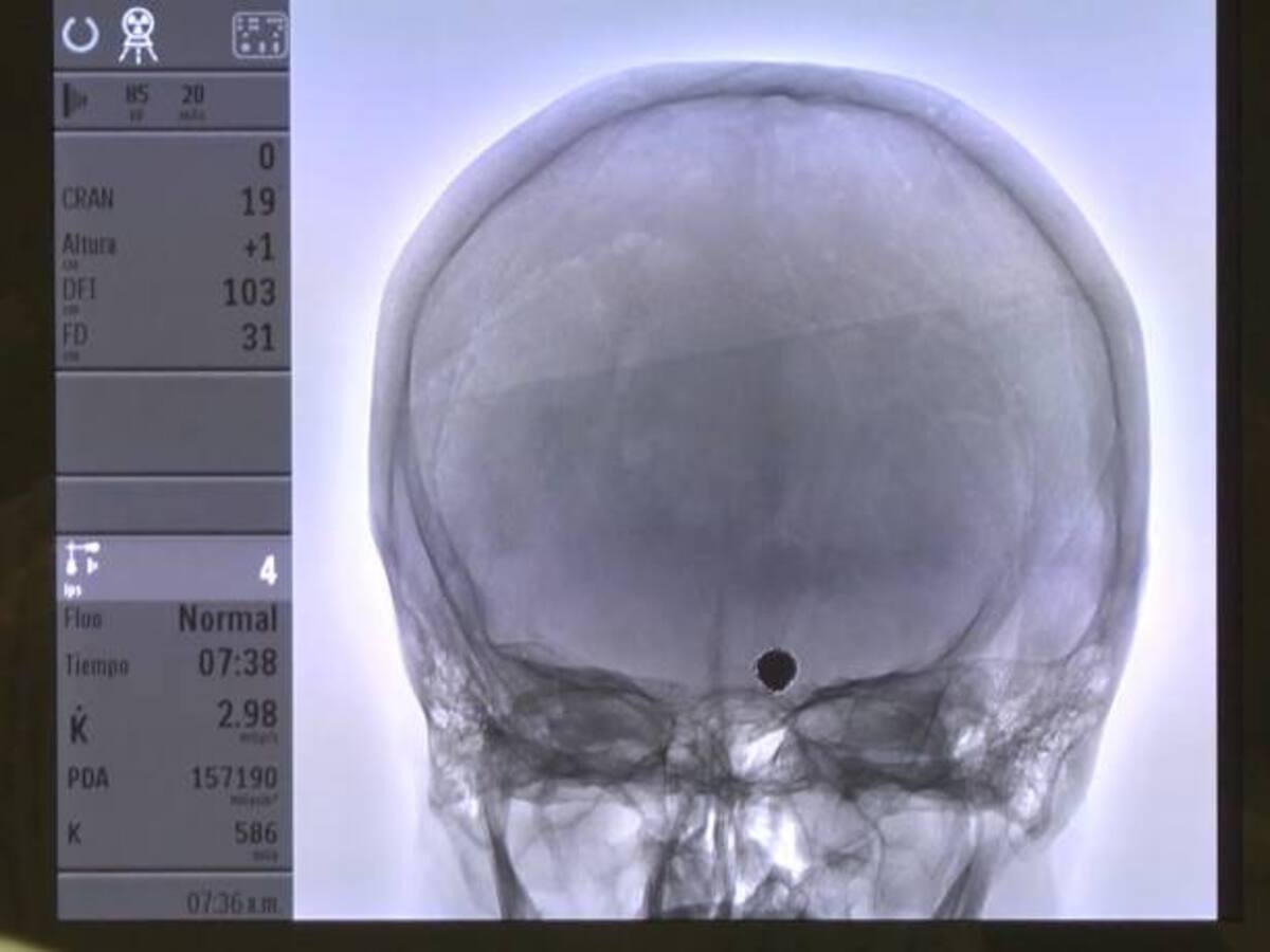 ¿Qué es un aneurisma?