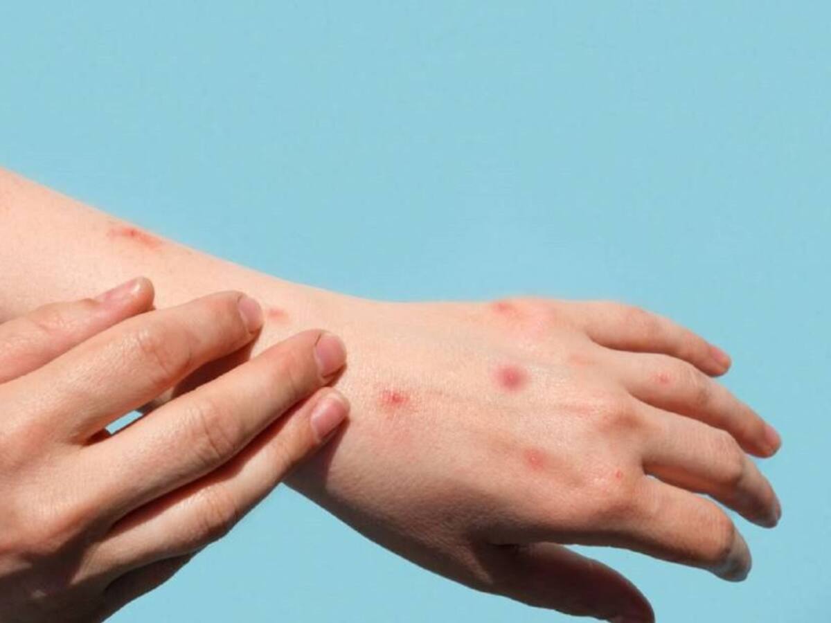 Reportan primer caso de viruela del mono en Malambo, Atlántico