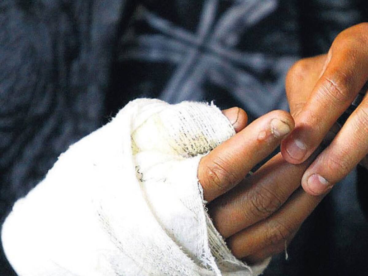 A 10 asciende la cifra de quemados por pólvora en el Huila