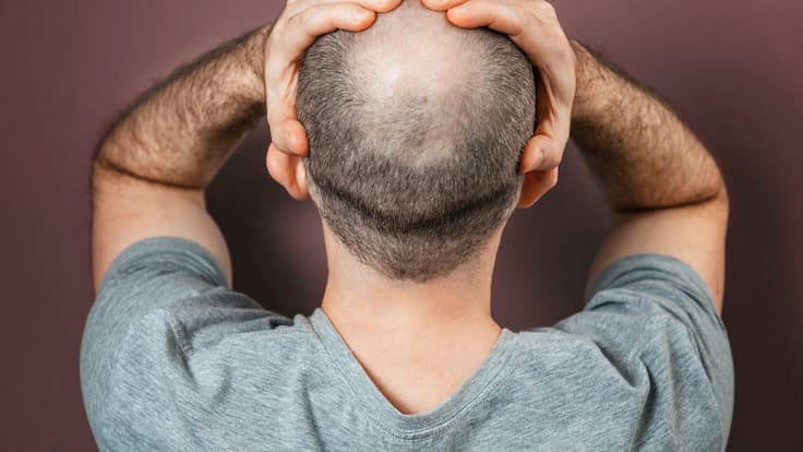 ¿Cómo reivindicar el orgullo de ser calvo? Responde el influenciador Harry James