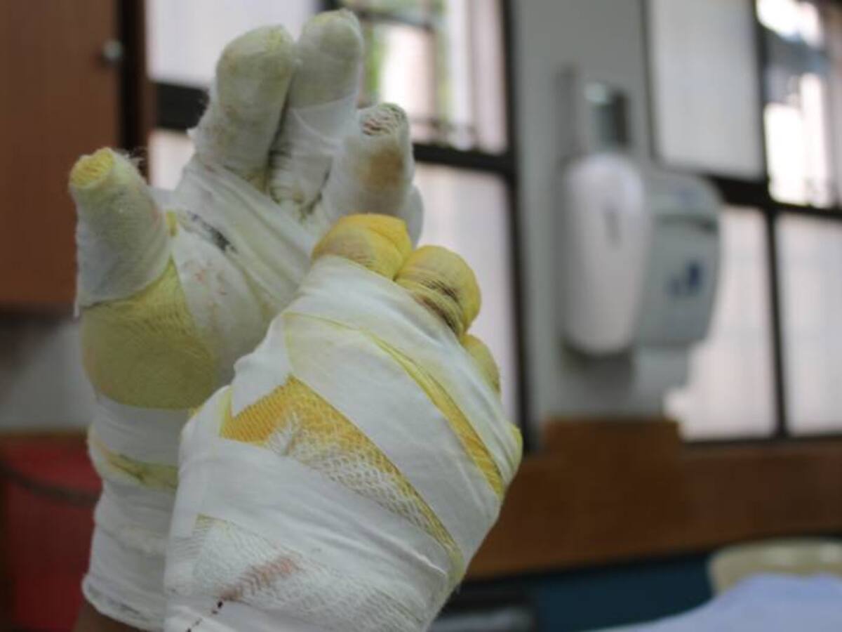 Antioquia se ‘quema’ con mayor número de lesionados con pólvora