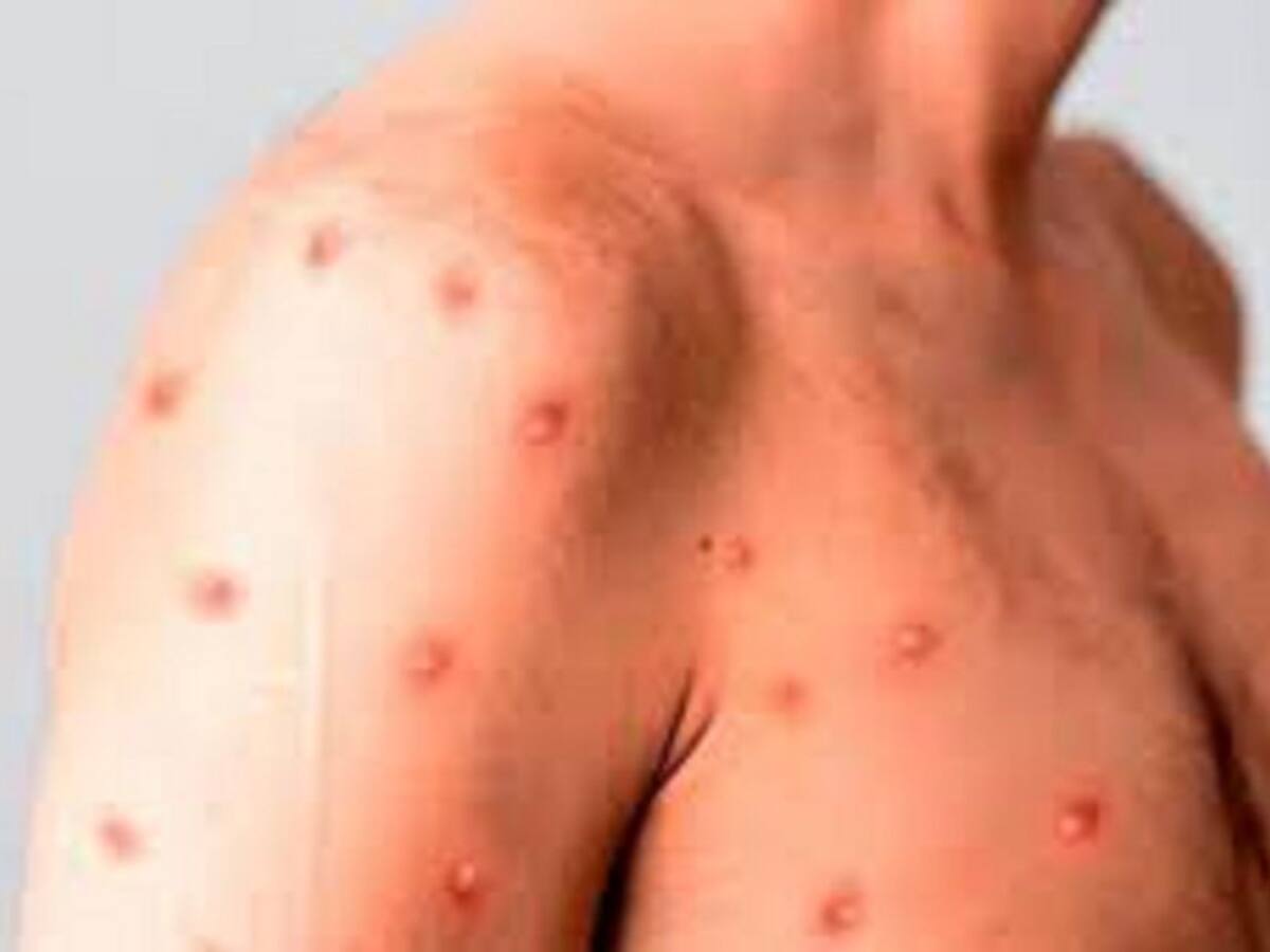 Segundo caso positivo de la Viruela del Mono es confirmado en Ibagué