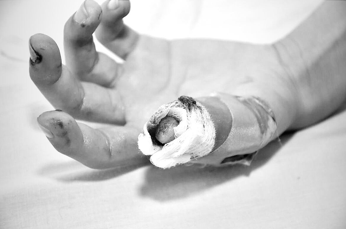 El niño permanece en el hospital Federico Lleras