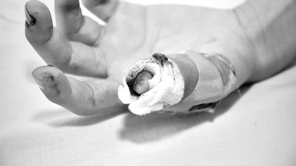 Se dispara la cifra de quemados con pólvora en Cúcuta durante Noche Buena