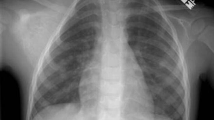 Diana Nieto vive una odisea desde que su hijo, de 8 años se tragó una piedra