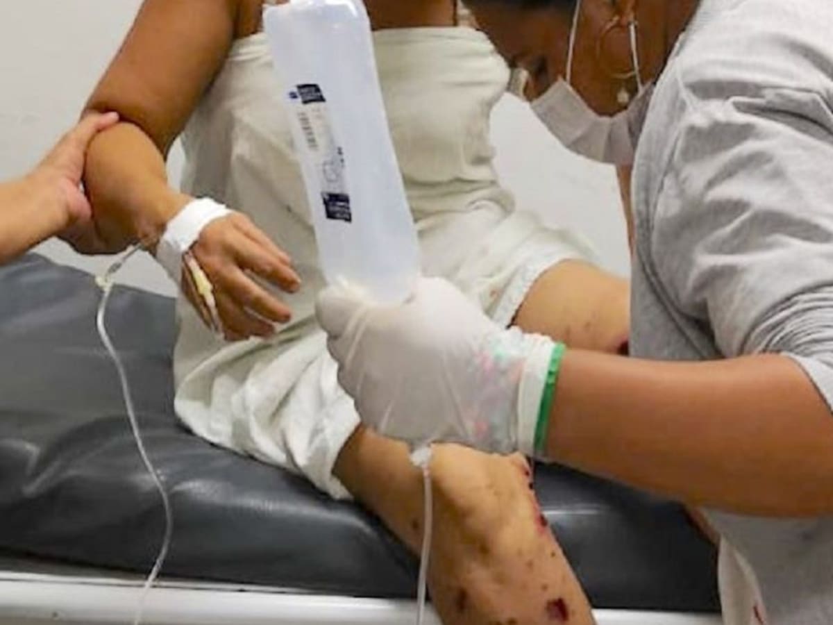 Van 4 quemados con pólvora durante el mes de diciembre en Córdoba