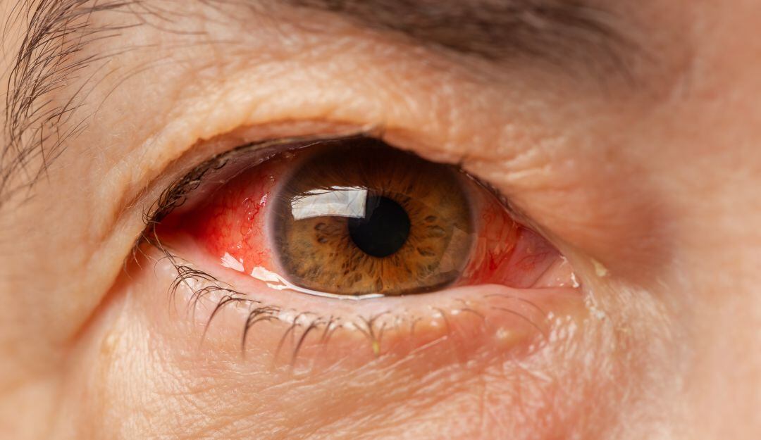 Imagen referencia ojos rojos