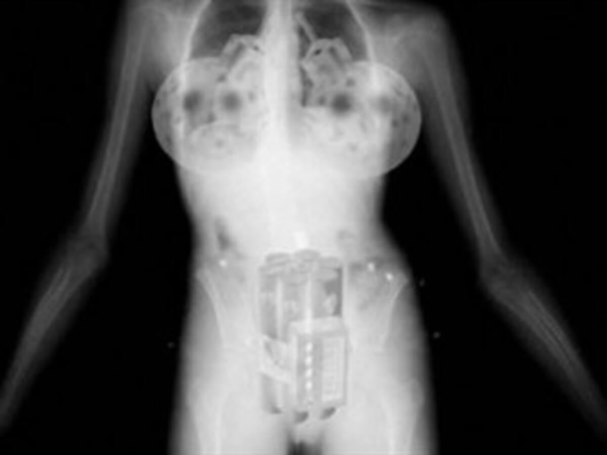 Reino Unido, atemorizado por posibles explosivos en implantes mamarios