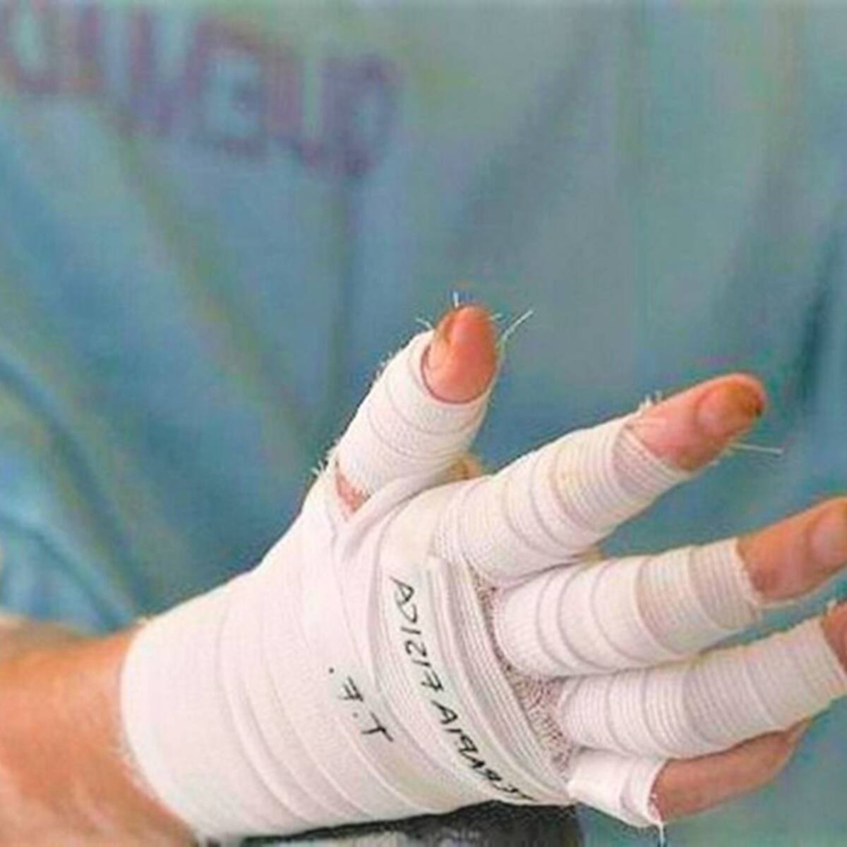 Antioquia llegó a 200 personas lesionadas por pólvora tras nuevo caso en un menor