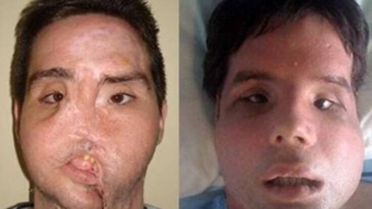 Primer trasplantado completo de cara en el mundo sale del hospital