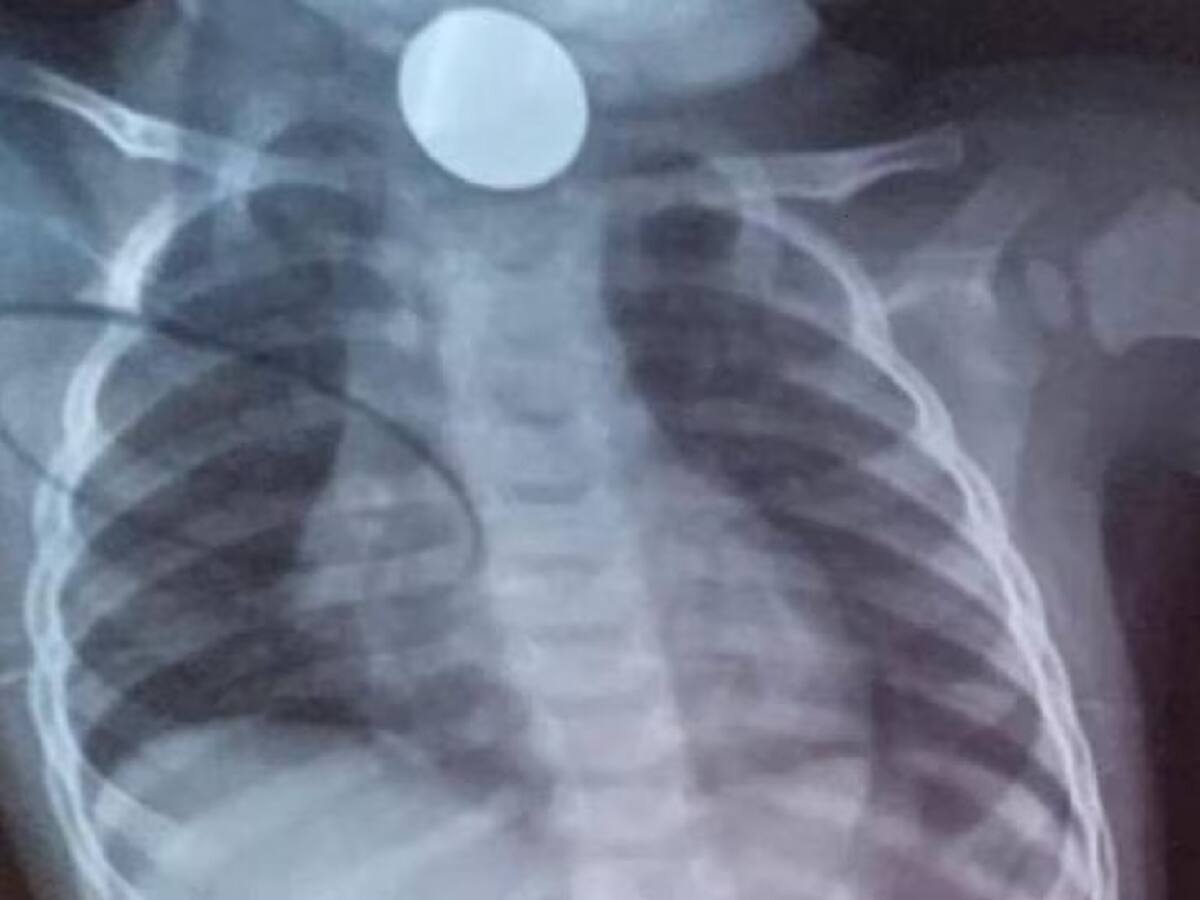 Denuncian que niño que se tragó una moneda no ha sido atendido por Asmet Salud