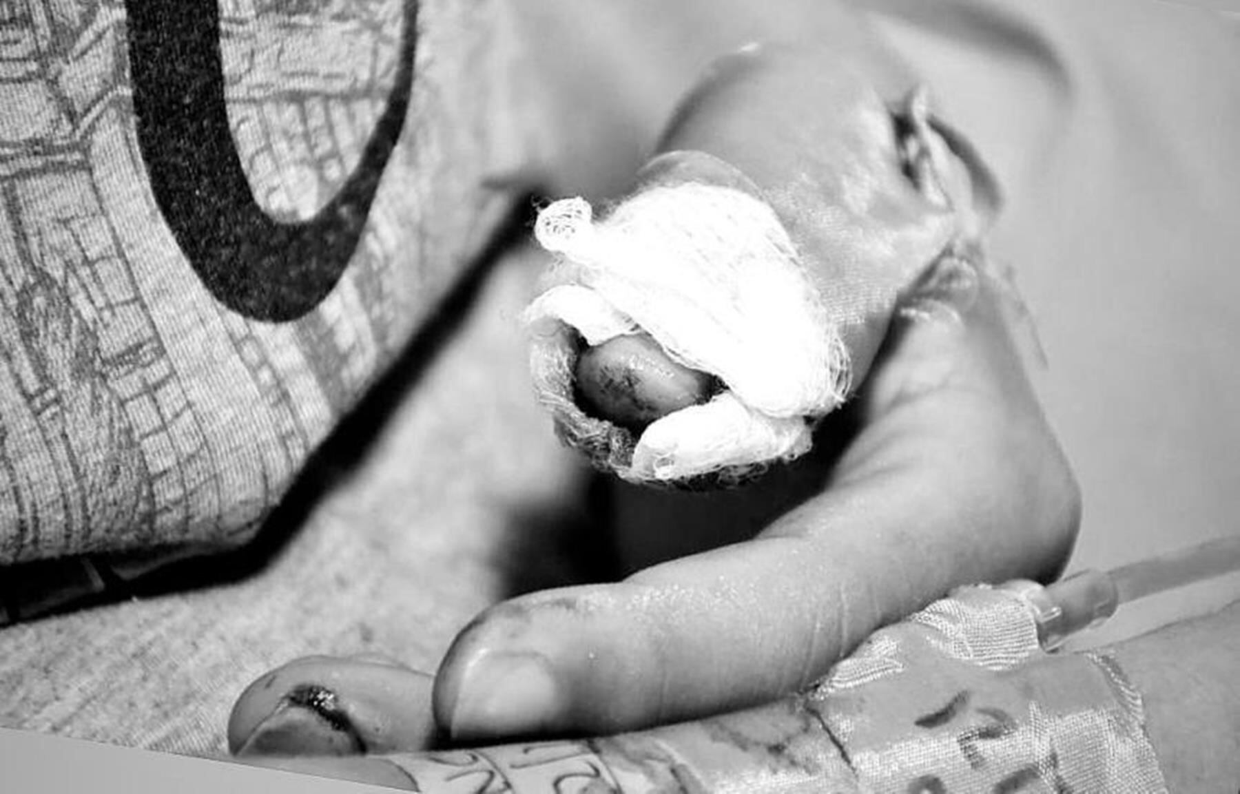 Herida ocasionada con pólvora