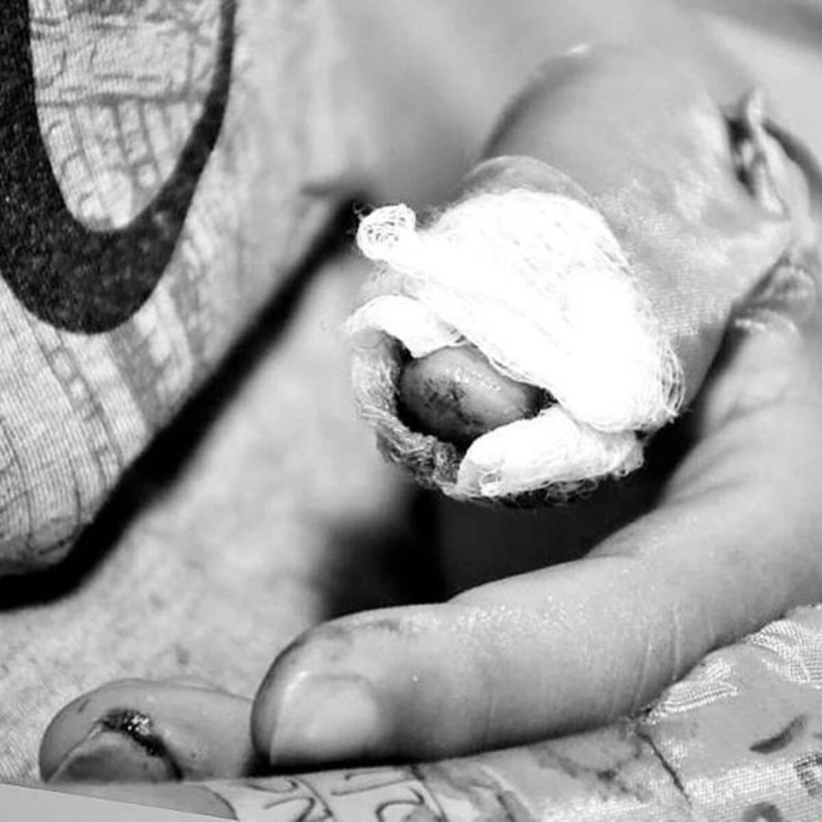 Denuncian primer caso de menor quemado con pólvora en Floridablanca