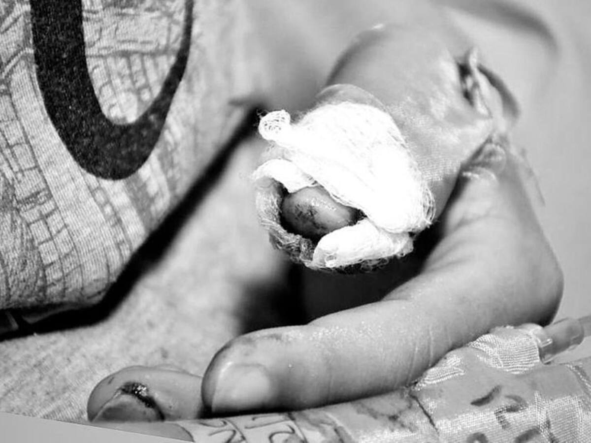 Sigue creciendo el número que lesionados por pólvora en el Tolima