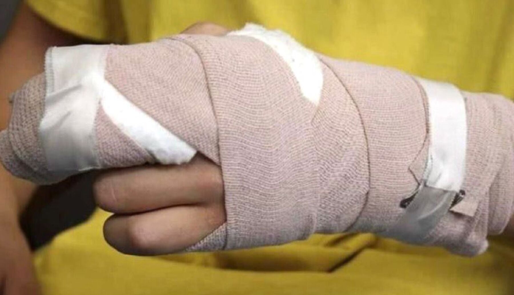 Referencia quemados con pólvora