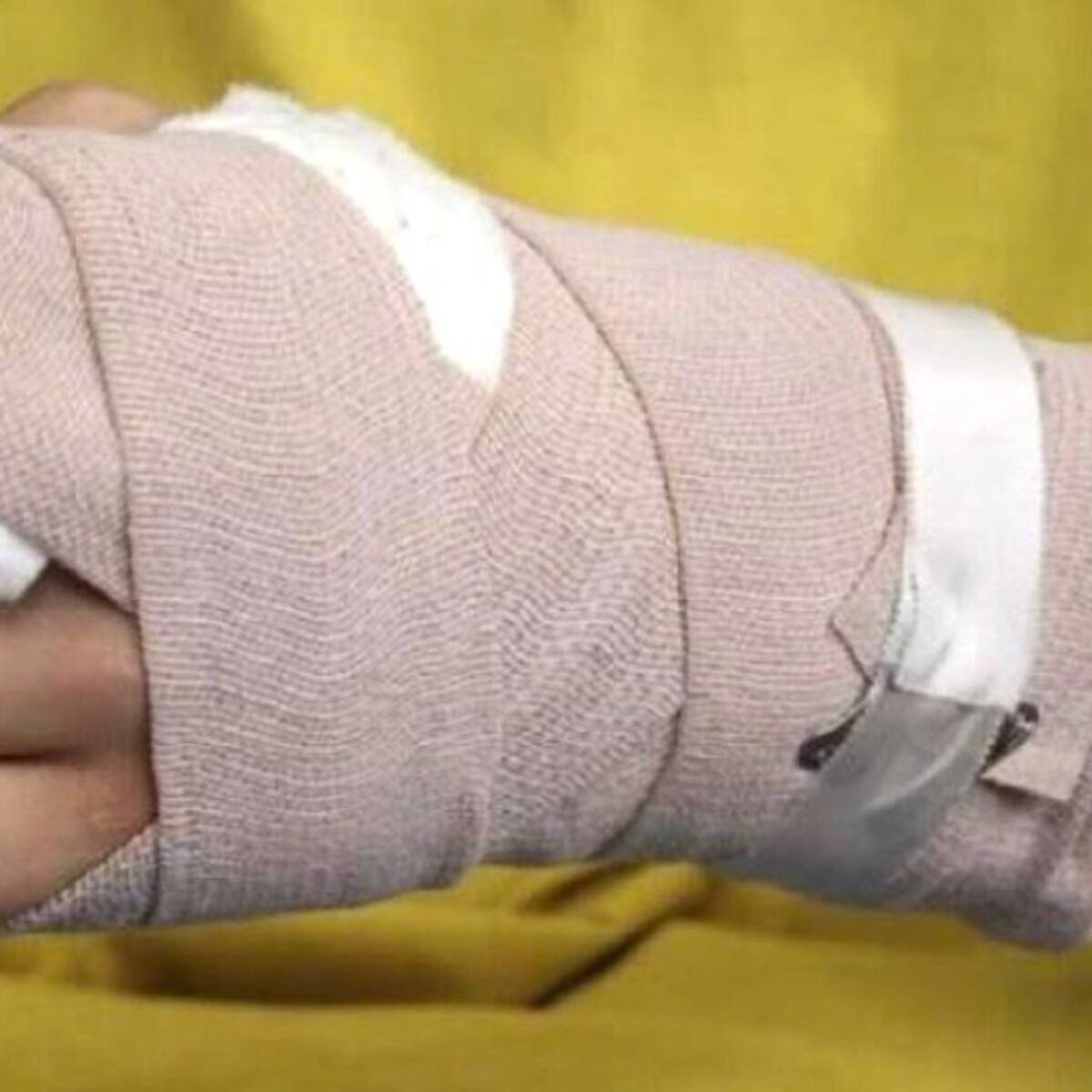 ICBF en el Quindío realiza seguimiento a los casos de menores quemados con pólvora