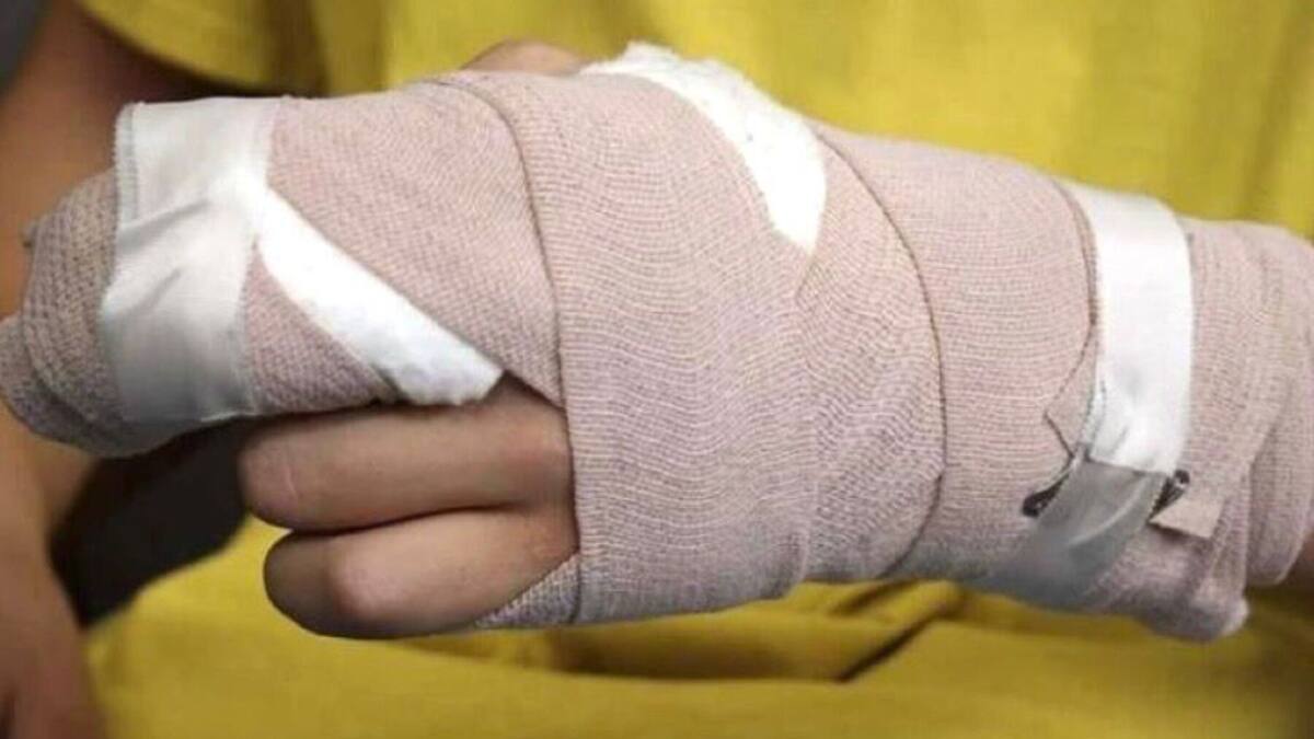 En Colombia se han reportado al menos 998 quemados con pólvora