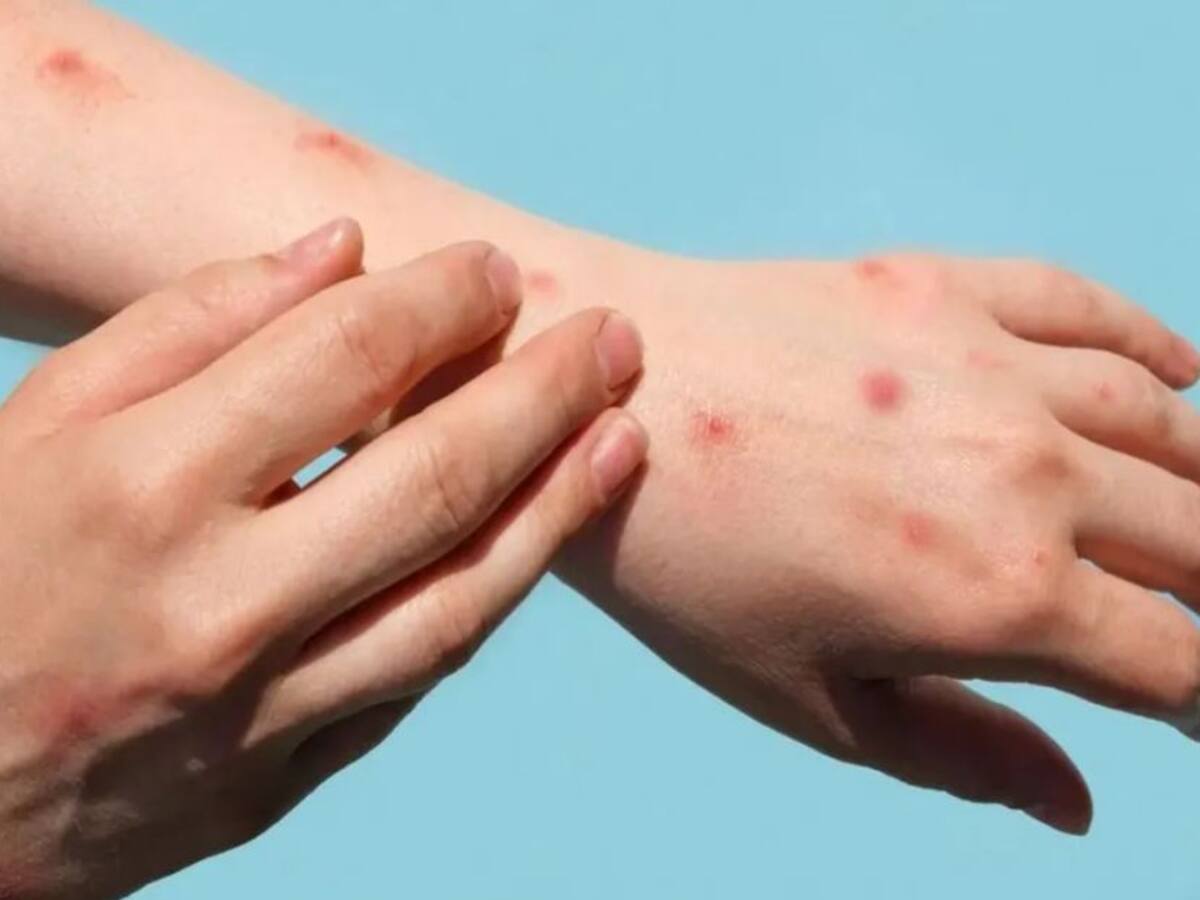 Confirman segundo caso de viruela del mono en Santander