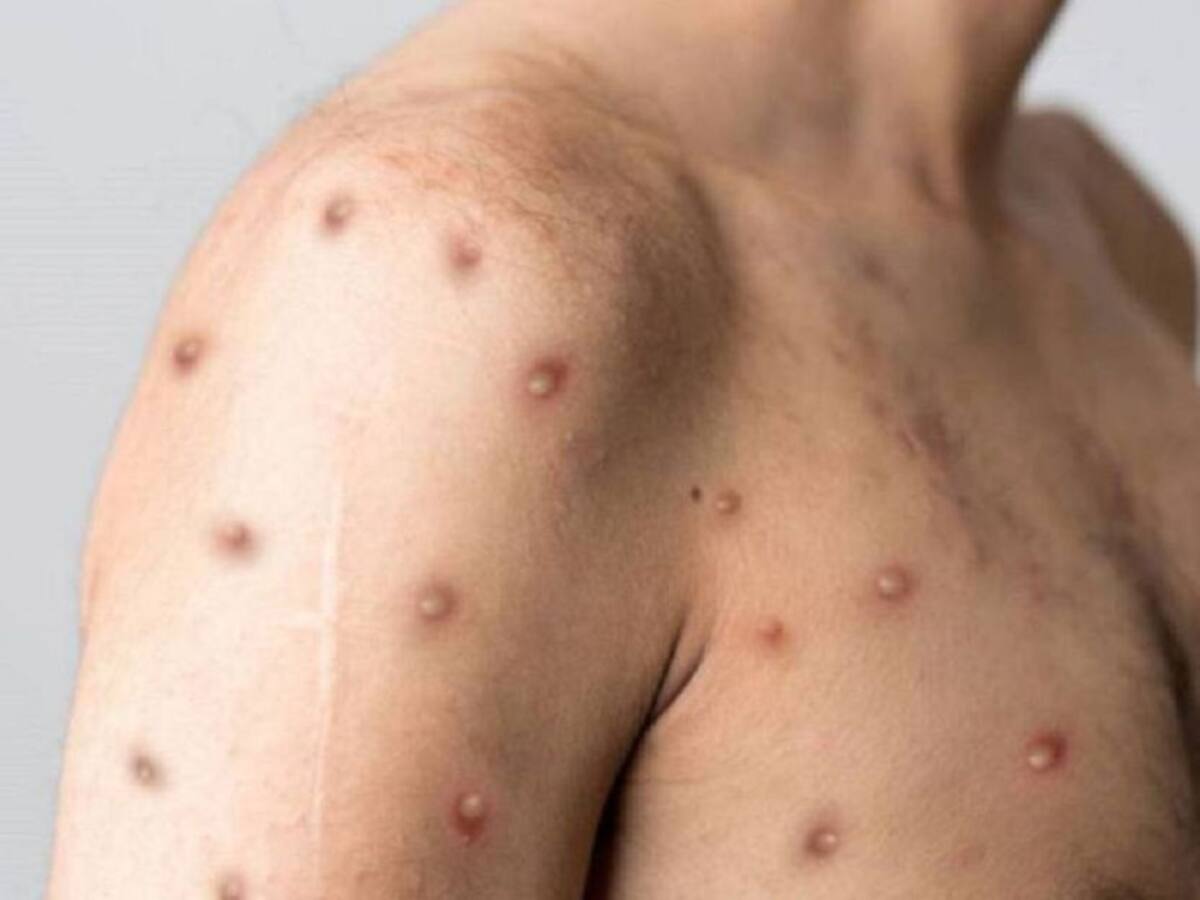 Cáceres tiene un caso sospechoso de la viruela Símica