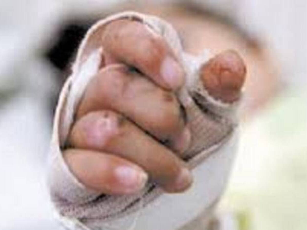 80 son los quemados con pólvora en el valle