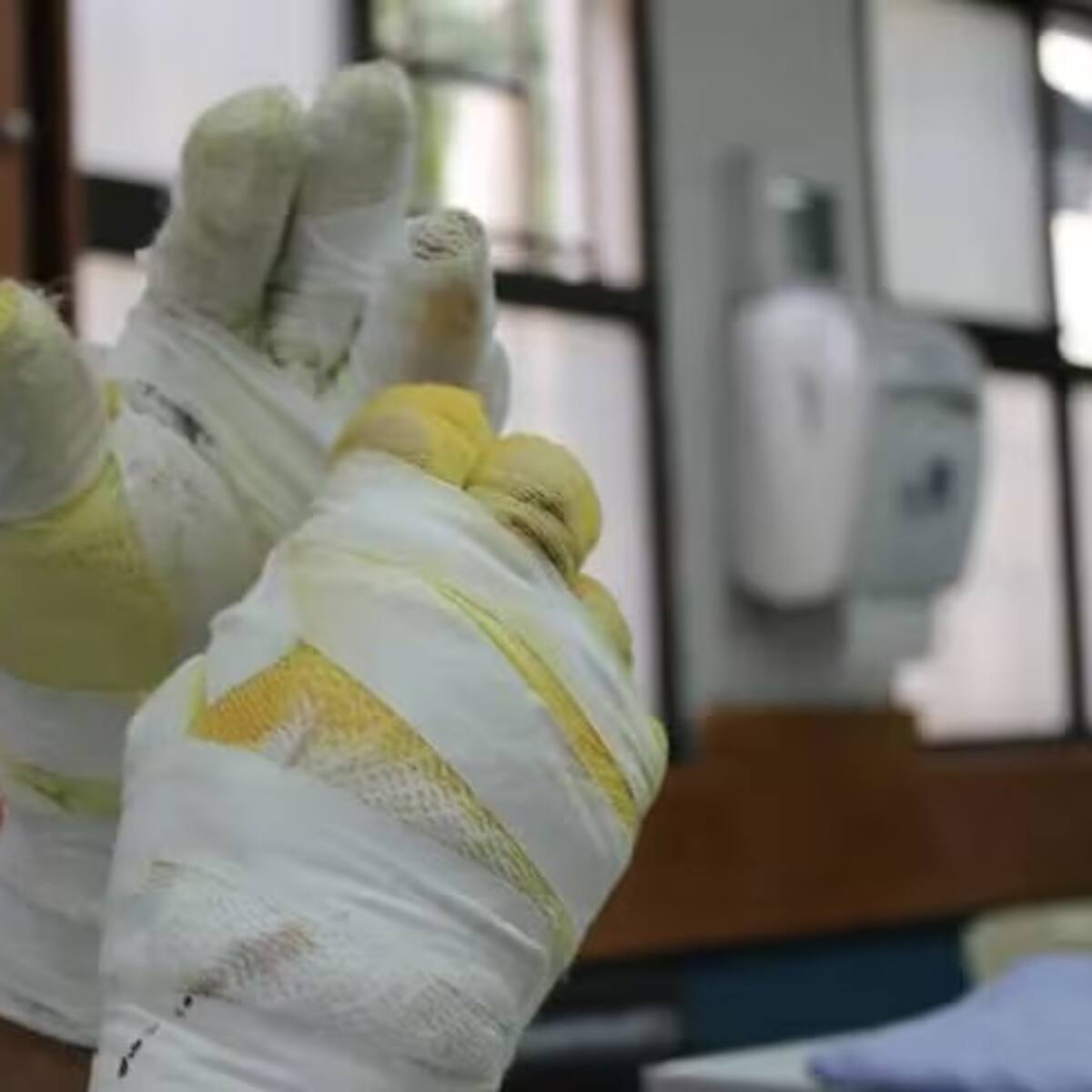 Caldas reporta a la fecha 11 quemados por pólvora, 7 de ellos en las noches de las velitas
