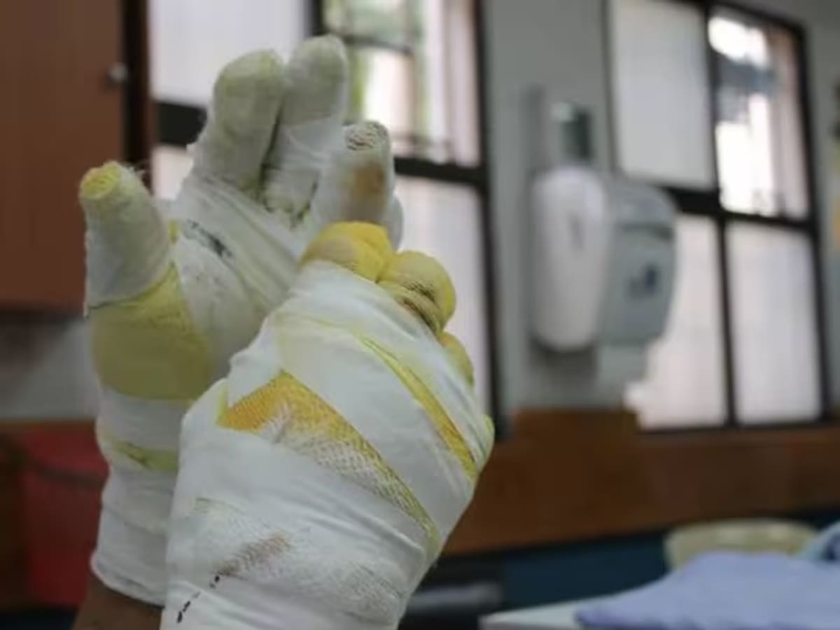 Caldas reporta a la fecha 11 quemados por pólvora, 7 de ellos en las noches de las velitas