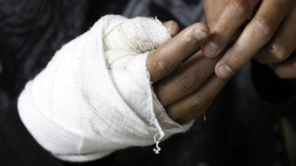 A 63 aumentó la cifra de quemados con pólvora en Santander