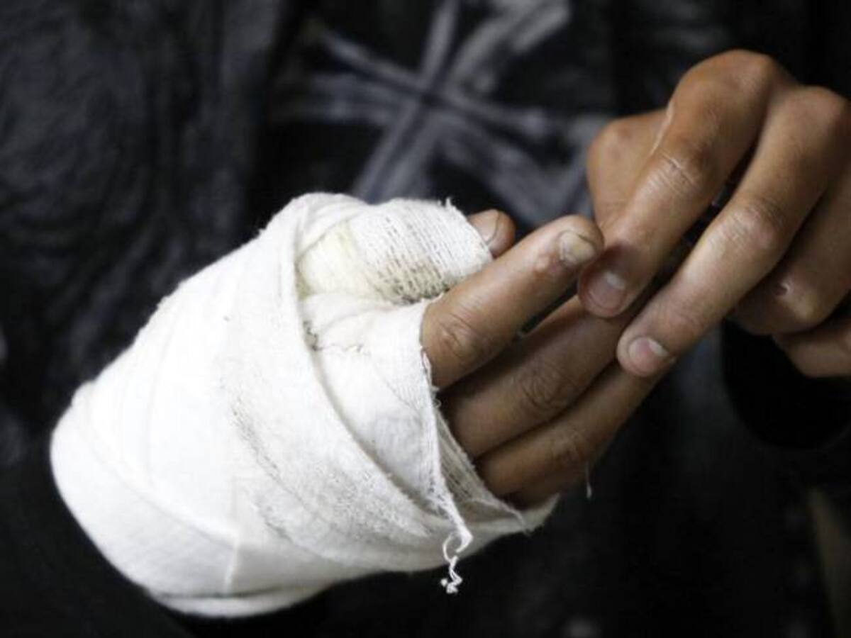 A 63 aumentó la cifra de quemados con pólvora en Santander