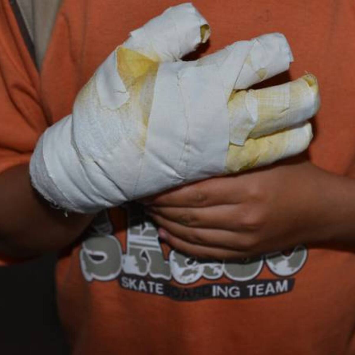 Menor de 13 años es la nueva víctima en Manizales de quemaduras con pólvora