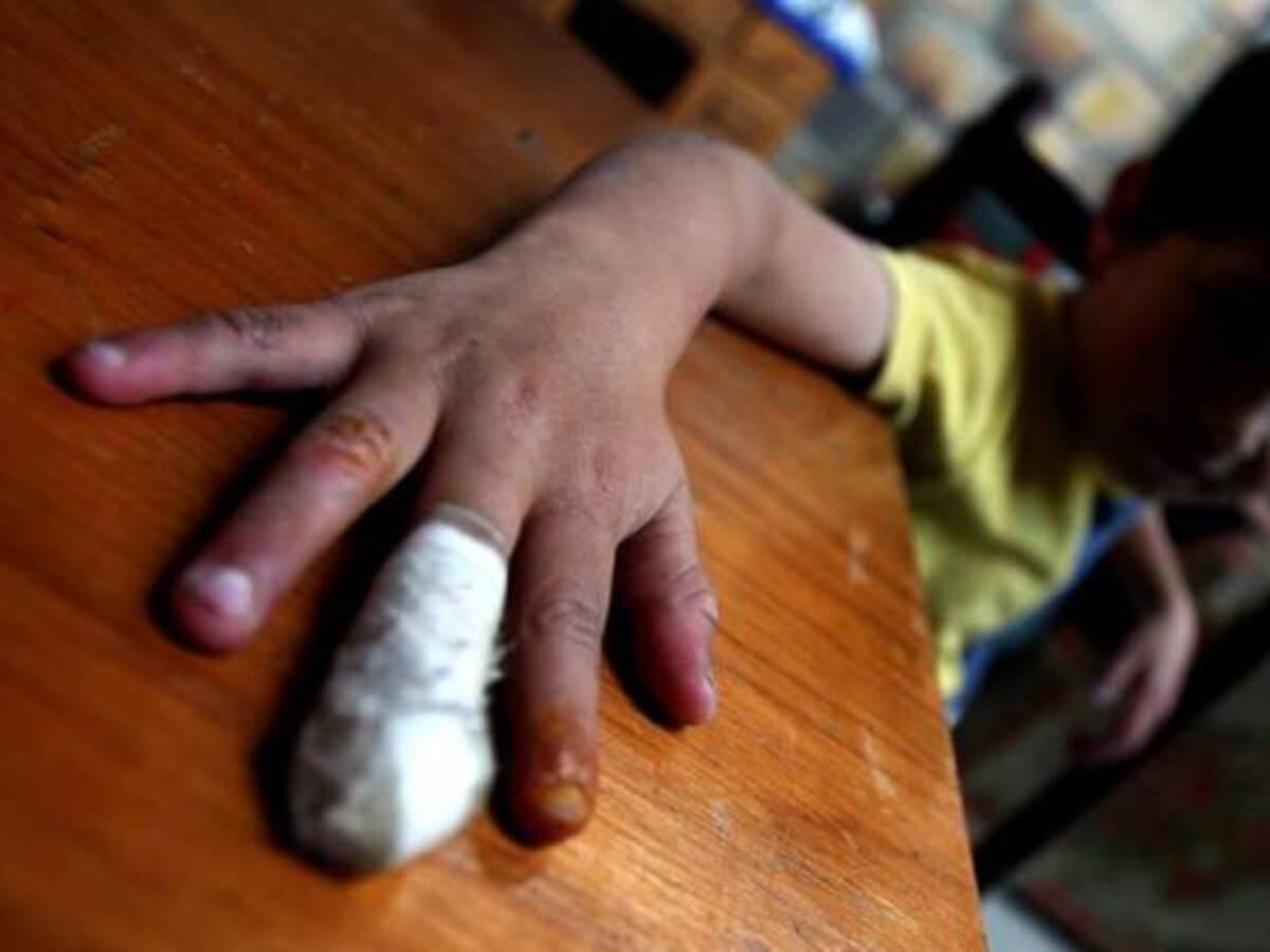 Lesionados por pólvora aumentaron a 283