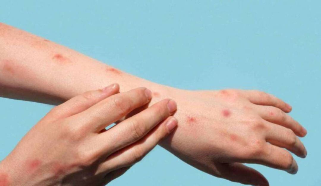 Nuevos casos de viruela del mono en Pereira.