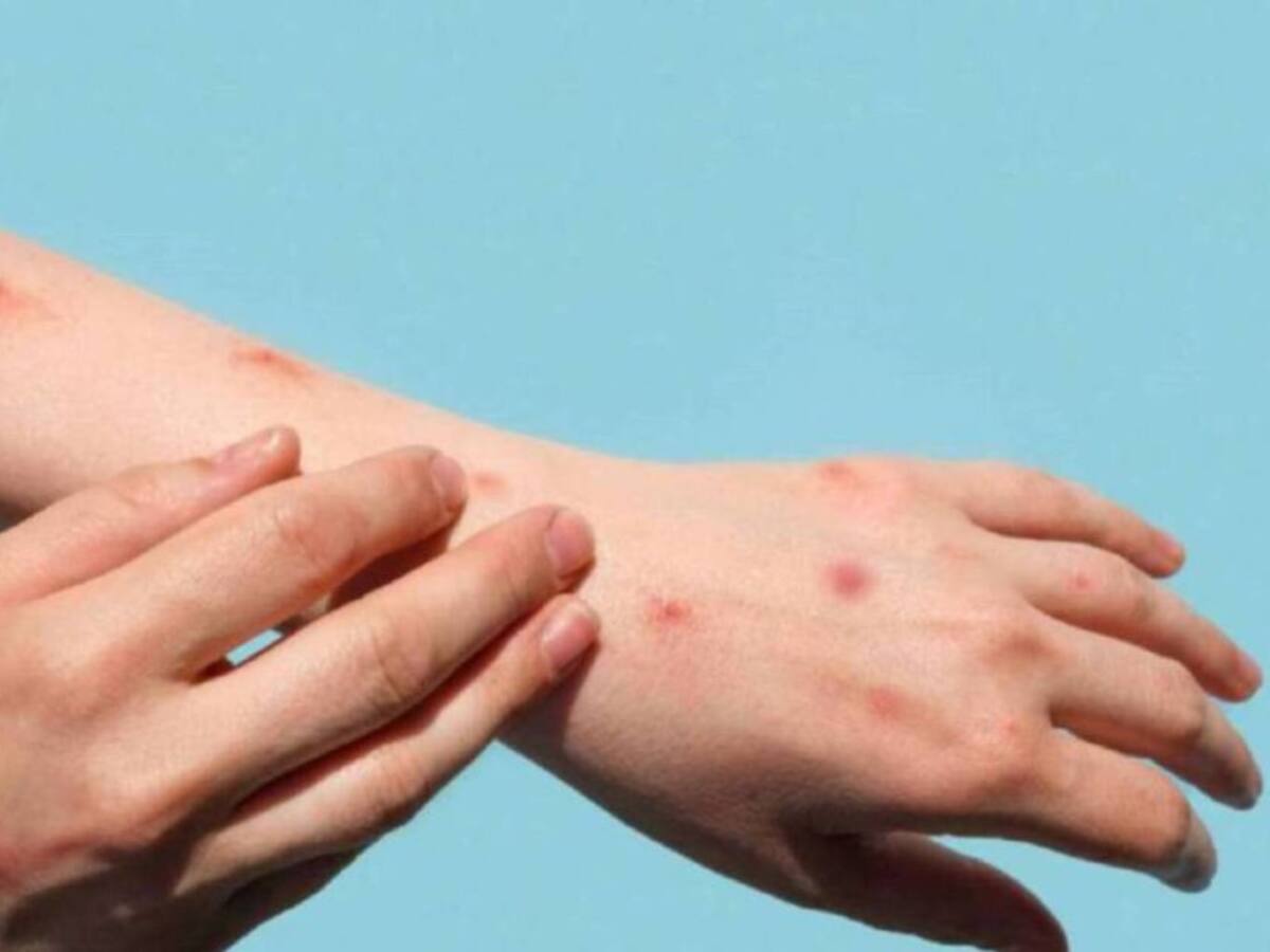 En septiembre se han duplicado los casos de viruela del mono en Risaralda