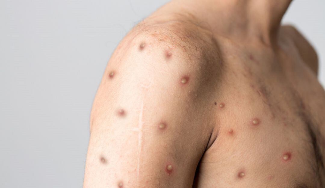 Primer caso de la viruela símica en el Quindío