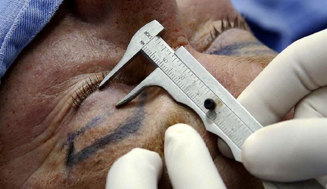 Cirugías de parpados y ojeras, para tratar los signos del envejecimiento