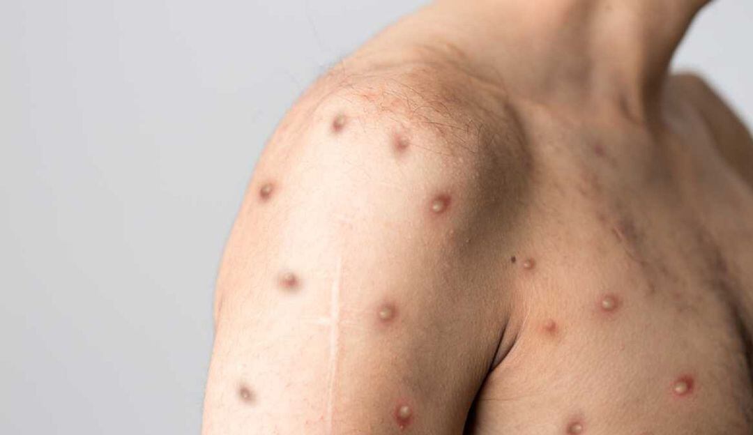 Minsalud aumenta medidas para frenar contagios por viruela del mono