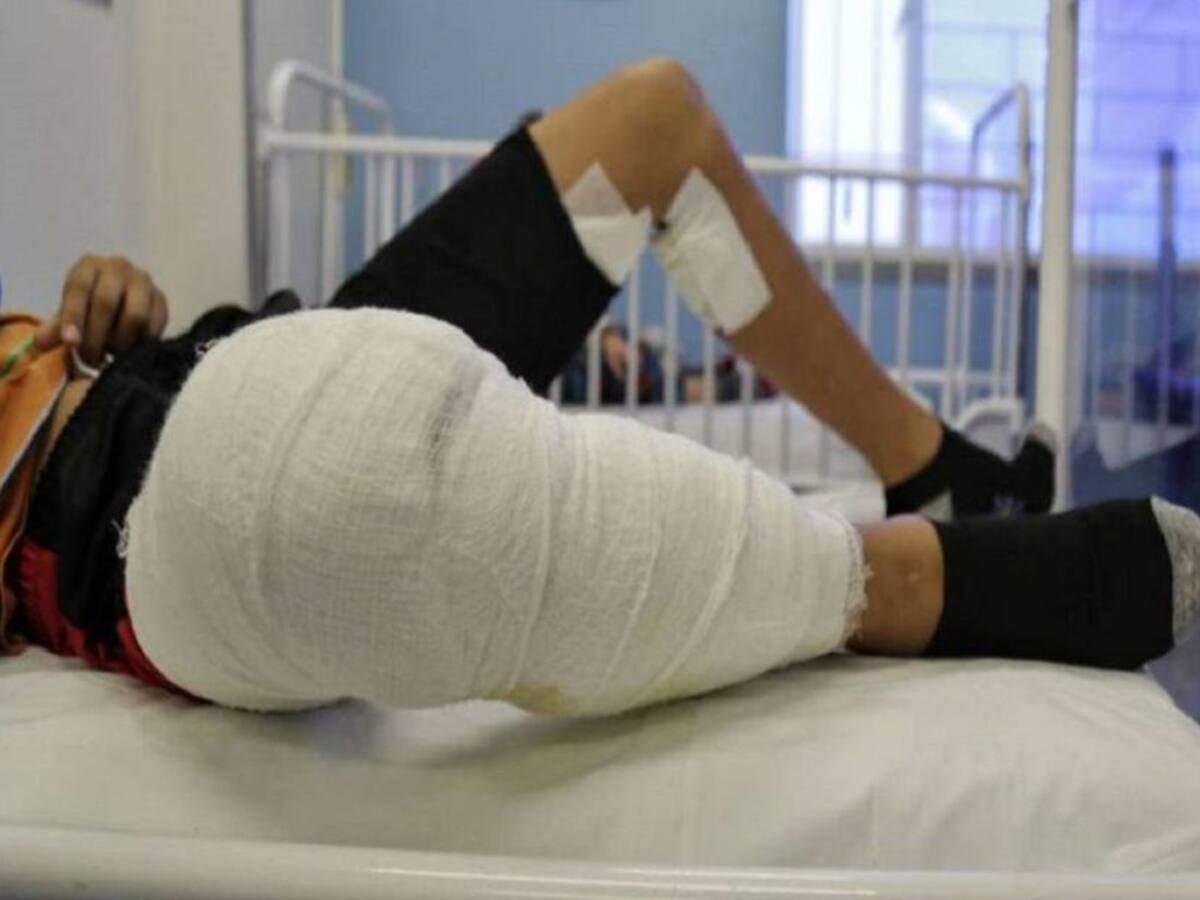 UCI en Medellín podrían colapsar si llegan quemados con pólvora