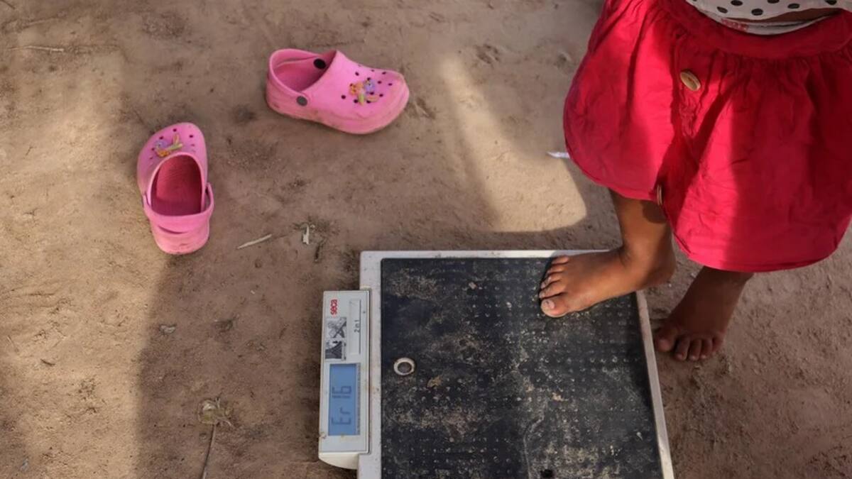 Continúa la preocupación por casos de desnutrición infantil en Risaralda