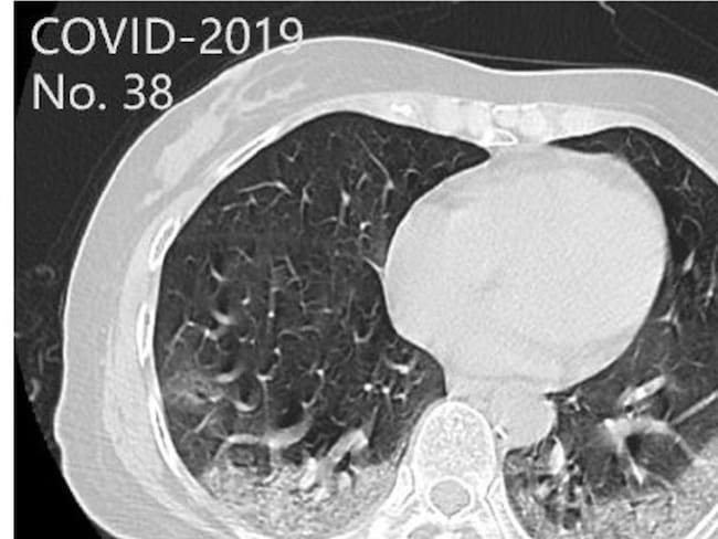 Crean sistema para detectar coronavirus con imágenes rayos X