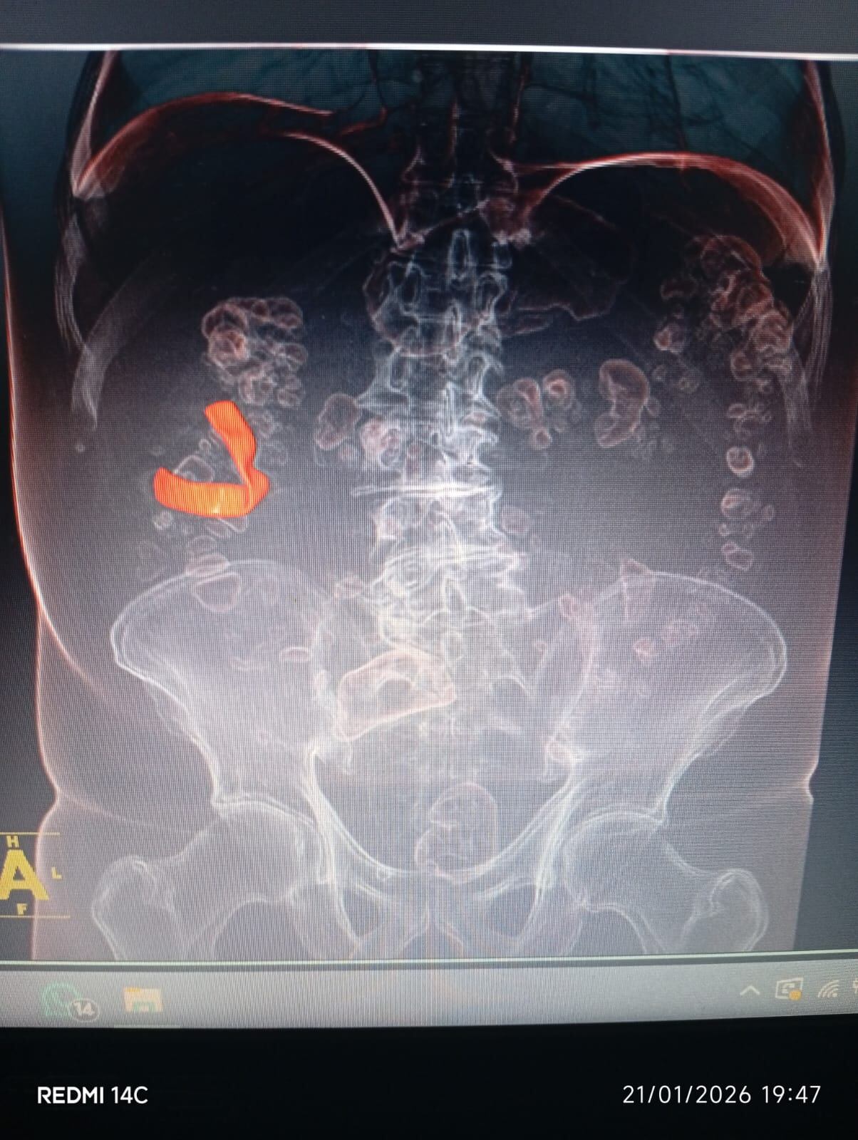 El hallazgo se produjo tras exámenes realizados en 2025, luego de años de molestias abdominales persistentes.